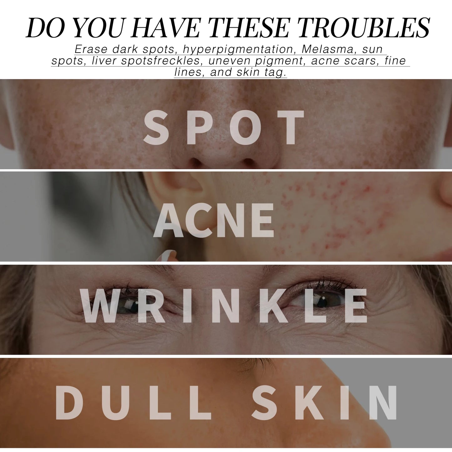 Facial Dark Spot Remover Acne Marks Moisturizer