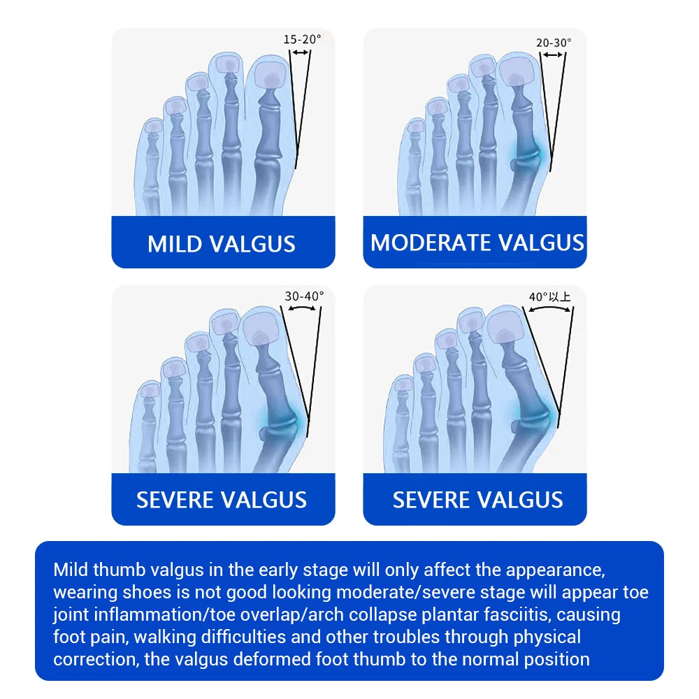 Bunion Corrector Toe Separator  Orthotics  Straightener Foot
