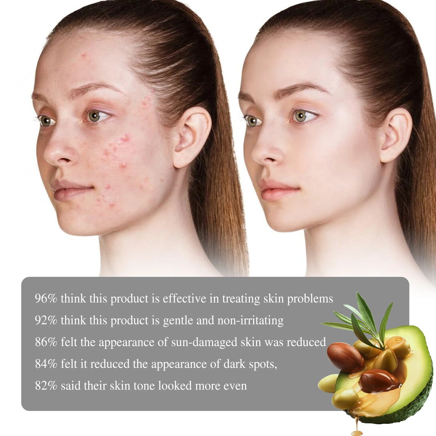 Facial Dark Spot Remover  Acne Marks Moisturizer